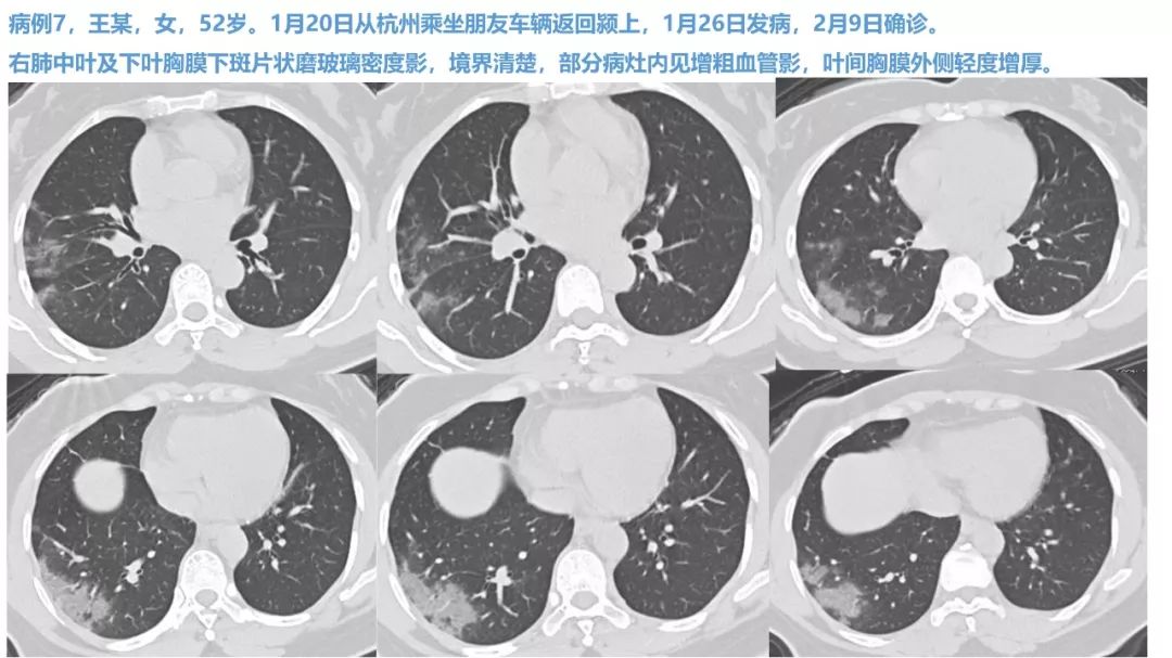 【PPT】新型冠状病毒肺炎NCP确诊病例汇总