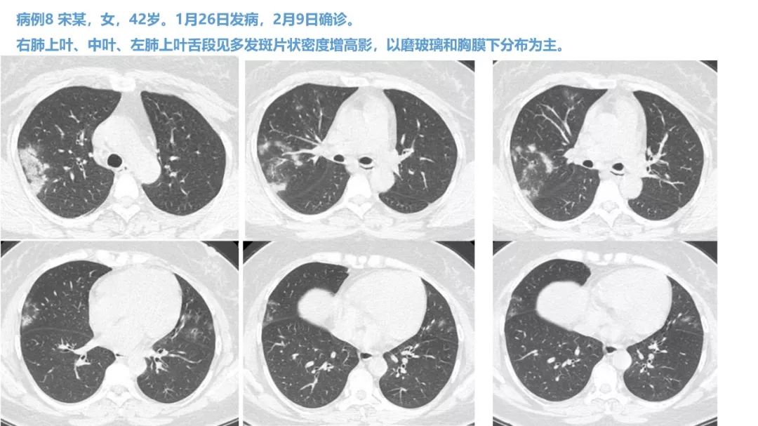 【PPT】新型冠状病毒肺炎NCP确诊病例汇总