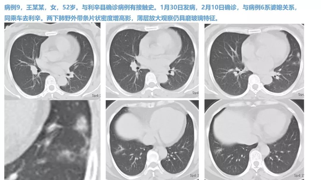 【PPT】新型冠状病毒肺炎NCP确诊病例汇总