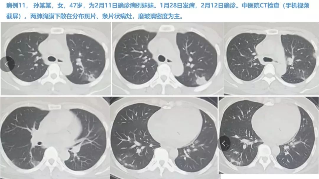 【PPT】新型冠状病毒肺炎NCP确诊病例汇总