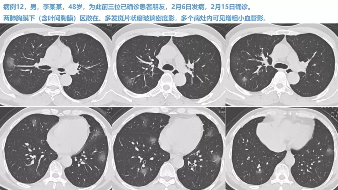 【PPT】新型冠状病毒肺炎NCP确诊病例汇总