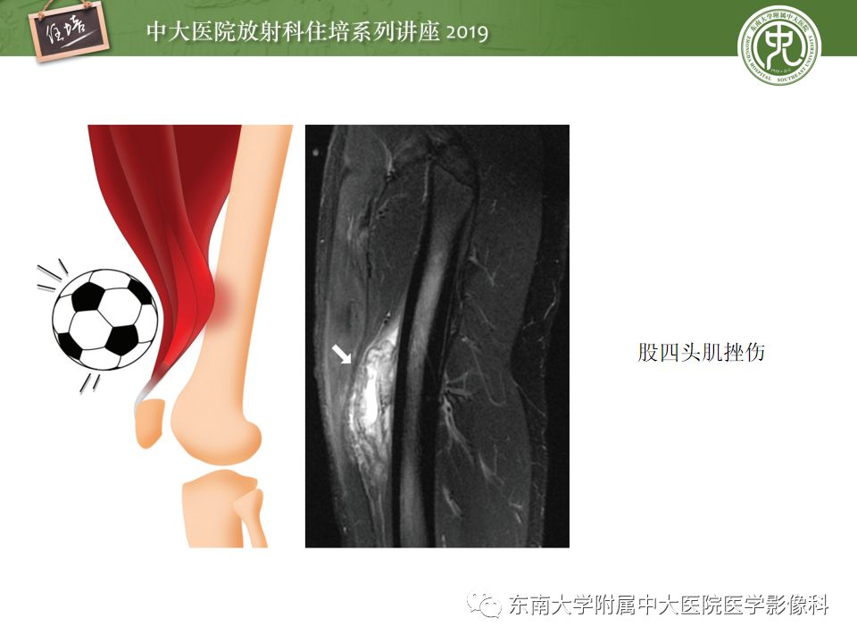 【PPT】创伤性肌肉病变的MR诊断