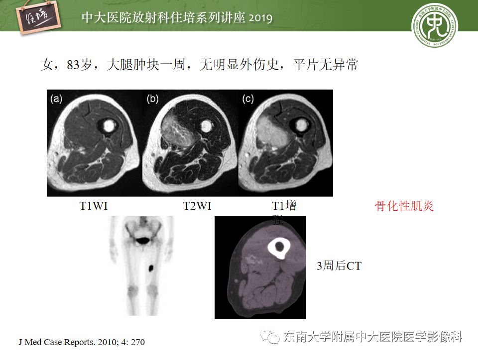 【PPT】创伤性肌肉病变的MR诊断