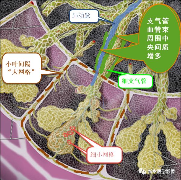 尝试用“破苍蝇拍征”+“包水管征”重读新冠肺炎早期磨玻璃影 尝试用“破苍蝇拍征”+“包水管征”重读新冠肺炎早期磨玻璃影