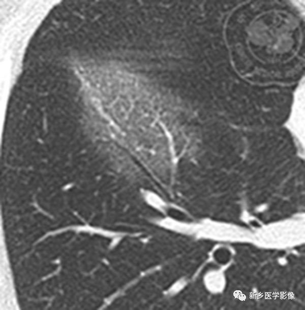 尝试用“破苍蝇拍征”+“包水管征”重读新冠肺炎早期磨玻璃影 尝试用“破苍蝇拍征”+“包水管征”重读新冠肺炎早期磨玻璃影