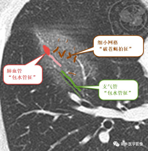 尝试用“破苍蝇拍征”+“包水管征”重读新冠肺炎早期磨玻璃影 尝试用“破苍蝇拍征”+“包水管征”重读新冠肺炎早期磨玻璃影