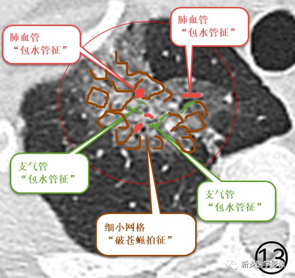 尝试用“破苍蝇拍征”+“包水管征”重读新冠肺炎早期磨玻璃影 尝试用“破苍蝇拍征”+“包水管征”重读新冠肺炎早期磨玻璃影