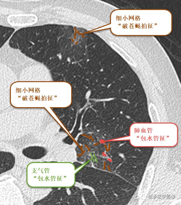 尝试用“破苍蝇拍征”+“包水管征”重读新冠肺炎早期磨玻璃影 尝试用“破苍蝇拍征”+“包水管征”重读新冠肺炎早期磨玻璃影