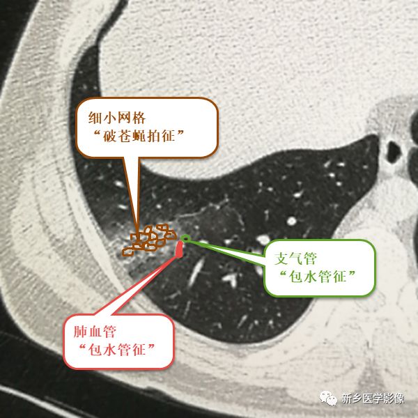 尝试用“破苍蝇拍征”+“包水管征”重读新冠肺炎早期磨玻璃影 尝试用“破苍蝇拍征”+“包水管征”重读新冠肺炎早期磨玻璃影
