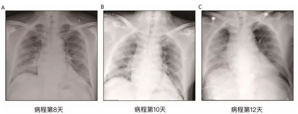 首例新冠肺炎病理解剖结果[全文翻译]