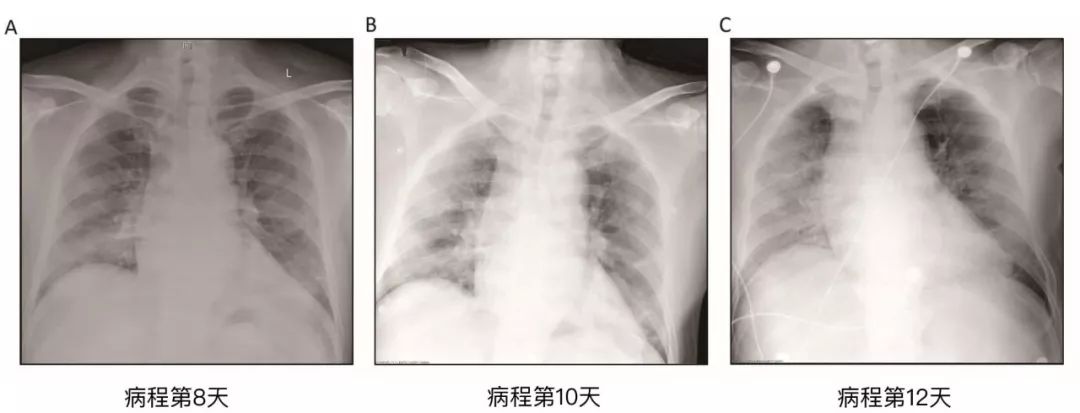 首例新冠肺炎病理解剖结果[全文翻译]