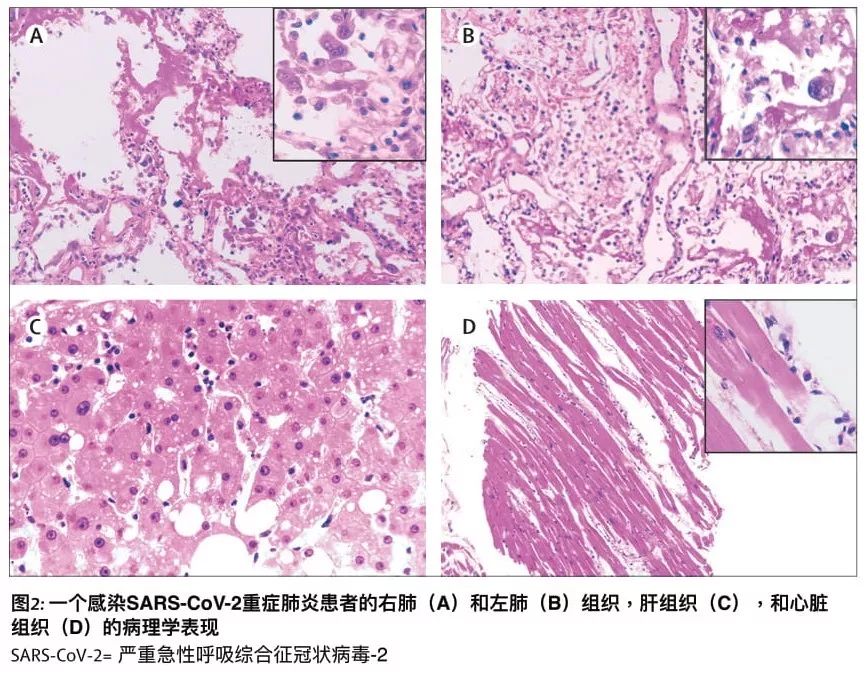 首例新冠肺炎病理解剖结果[全文翻译]