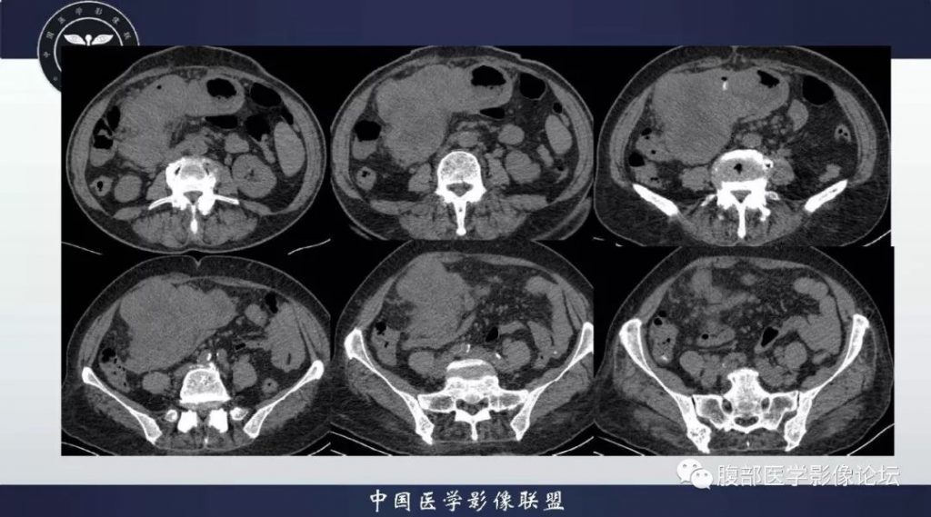 【病例】胃神经内分泌肿瘤1例影像诊断及鉴别诊断