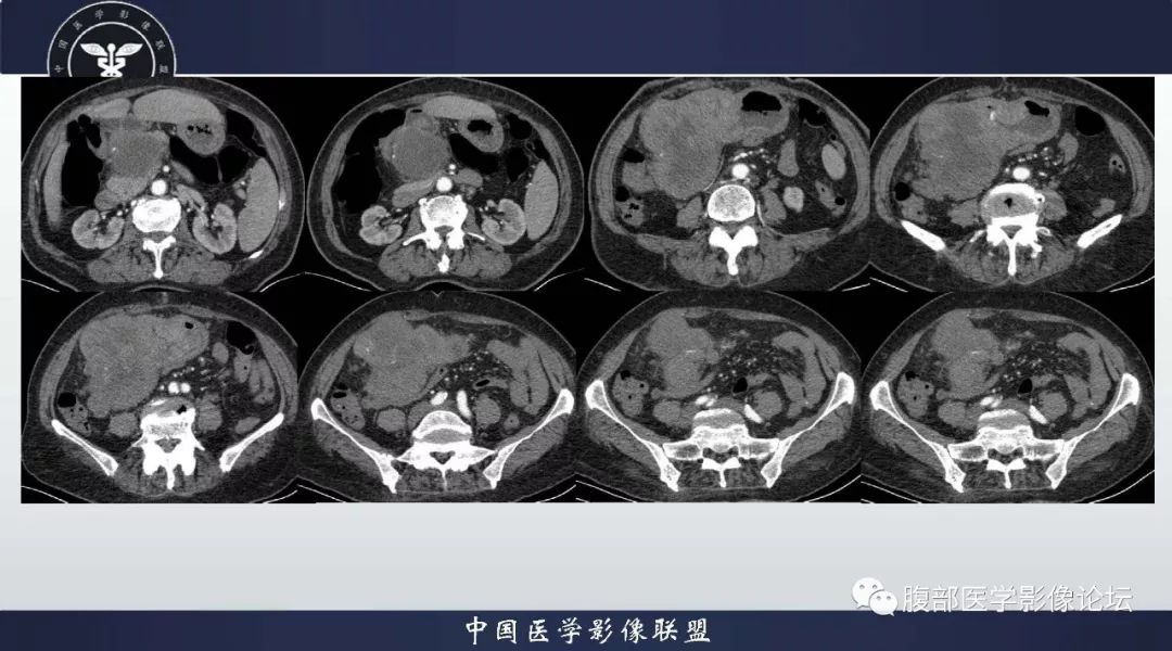 【病例】胃神经内分泌肿瘤1例影像诊断及鉴别诊断 【病例】胃神经内分泌肿瘤1例影像诊断及鉴别诊断
