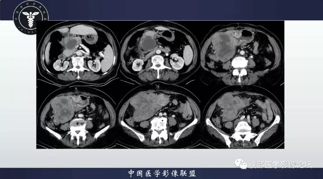 【病例】胃神经内分泌肿瘤1例影像诊断及鉴别诊断 【病例】胃神经内分泌肿瘤1例影像诊断及鉴别诊断
