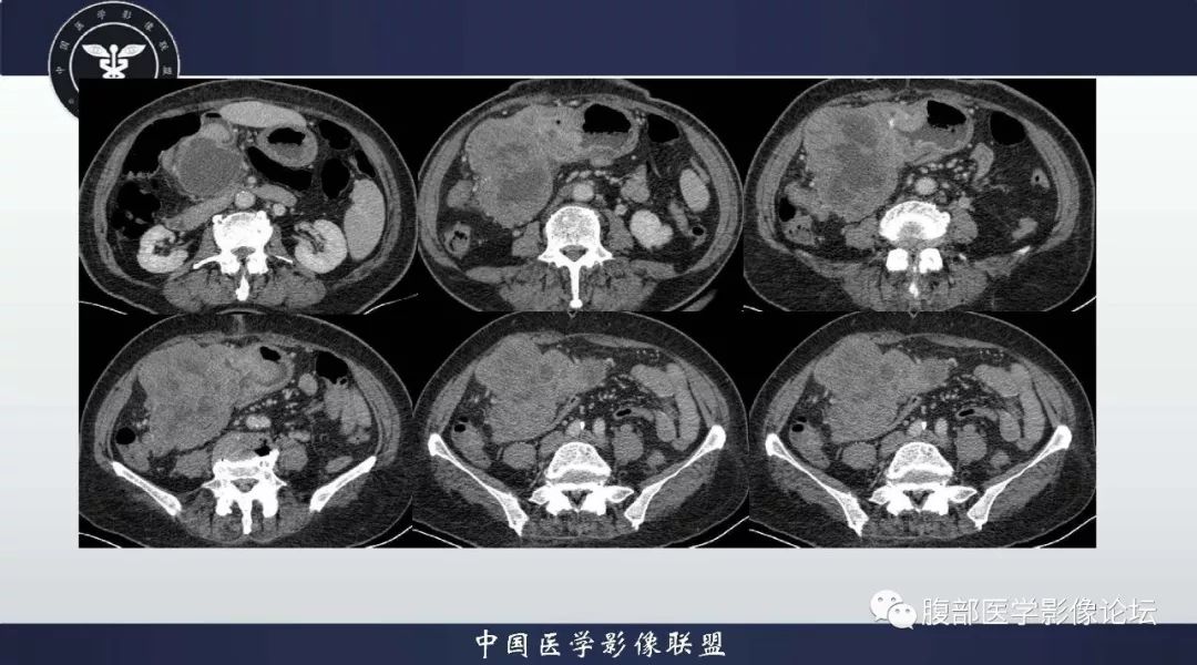 【病例】胃神经内分泌肿瘤1例影像诊断及鉴别诊断 【病例】胃神经内分泌肿瘤1例影像诊断及鉴别诊断