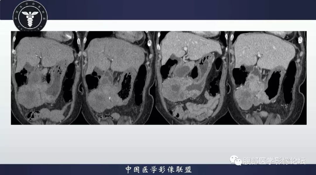 【病例】胃神经内分泌肿瘤1例影像诊断及鉴别诊断 【病例】胃神经内分泌肿瘤1例影像诊断及鉴别诊断