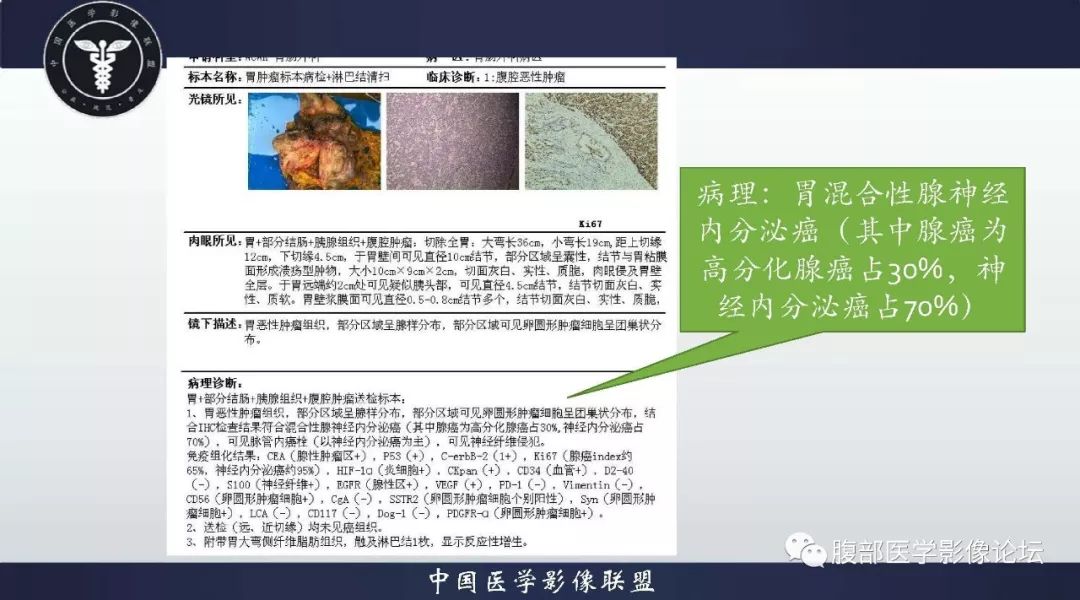 【病例】胃神经内分泌肿瘤1例影像诊断及鉴别诊断 【病例】胃神经内分泌肿瘤1例影像诊断及鉴别诊断