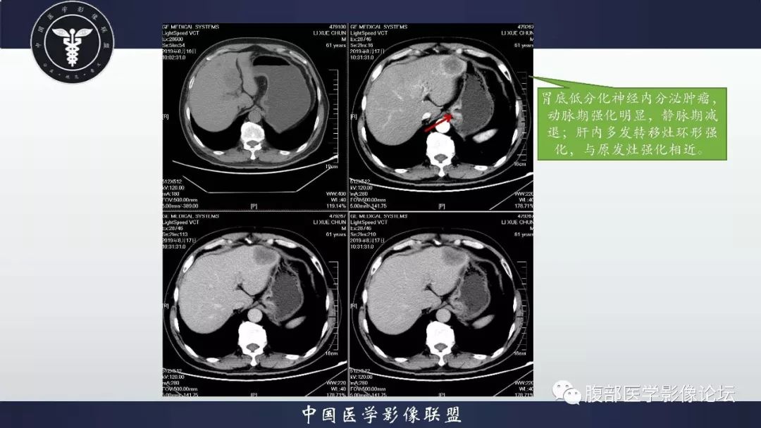 【病例】胃神经内分泌肿瘤1例影像诊断及鉴别诊断 【病例】胃神经内分泌肿瘤1例影像诊断及鉴别诊断