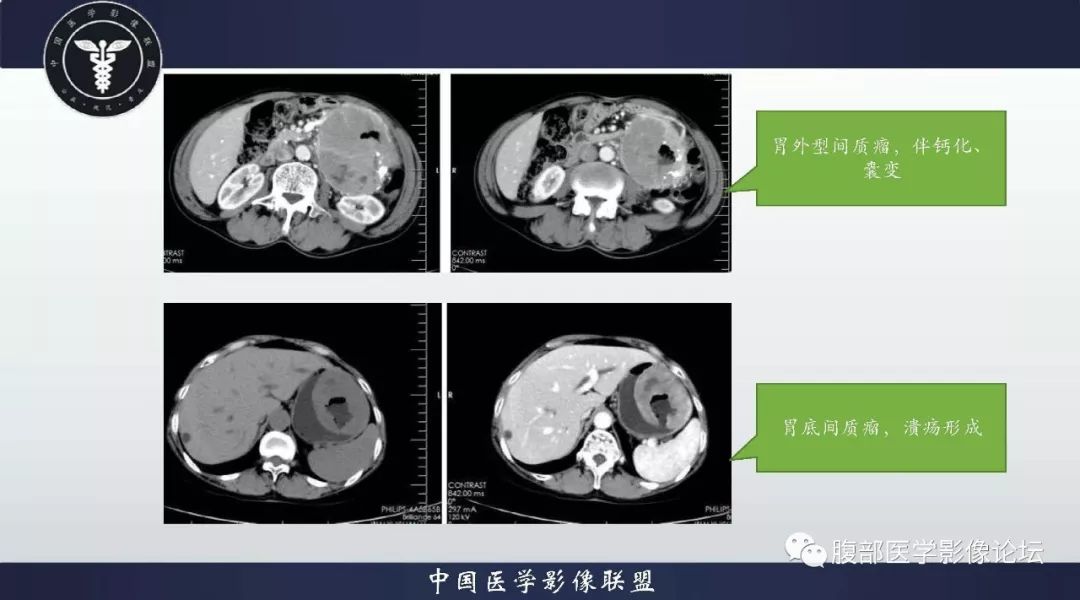 【病例】胃神经内分泌肿瘤1例影像诊断及鉴别诊断 【病例】胃神经内分泌肿瘤1例影像诊断及鉴别诊断