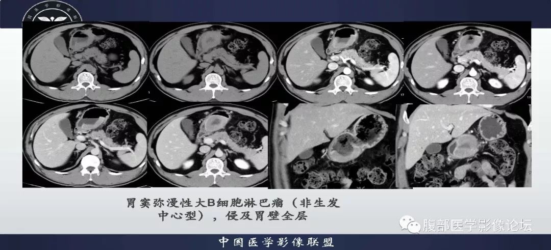 【病例】胃神经内分泌肿瘤1例影像诊断及鉴别诊断 【病例】胃神经内分泌肿瘤1例影像诊断及鉴别诊断