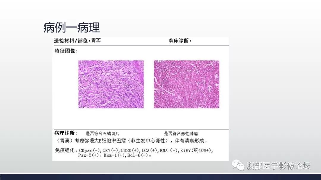 【病例】胃窦弥漫性大B细胞淋巴瘤1例CT影像