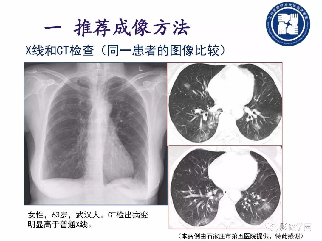 【PPT】新型冠状病毒肺炎影像学诊断指南解读