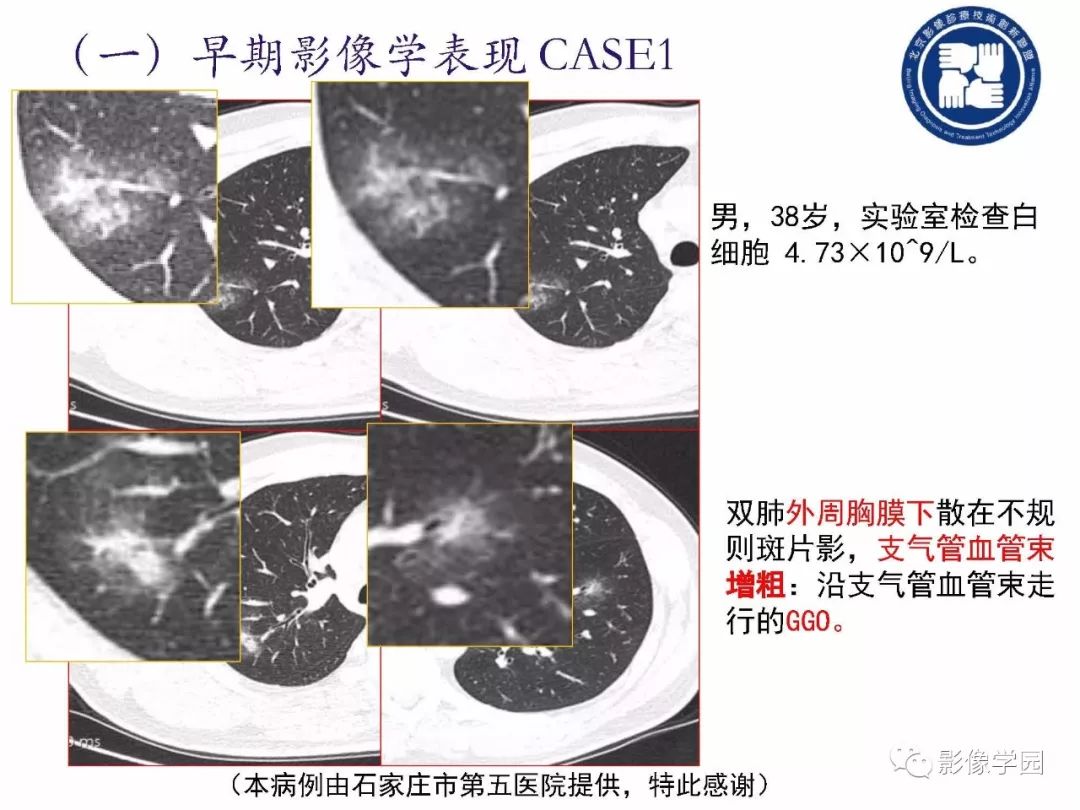 【PPT】新型冠状病毒肺炎影像学诊断指南解读