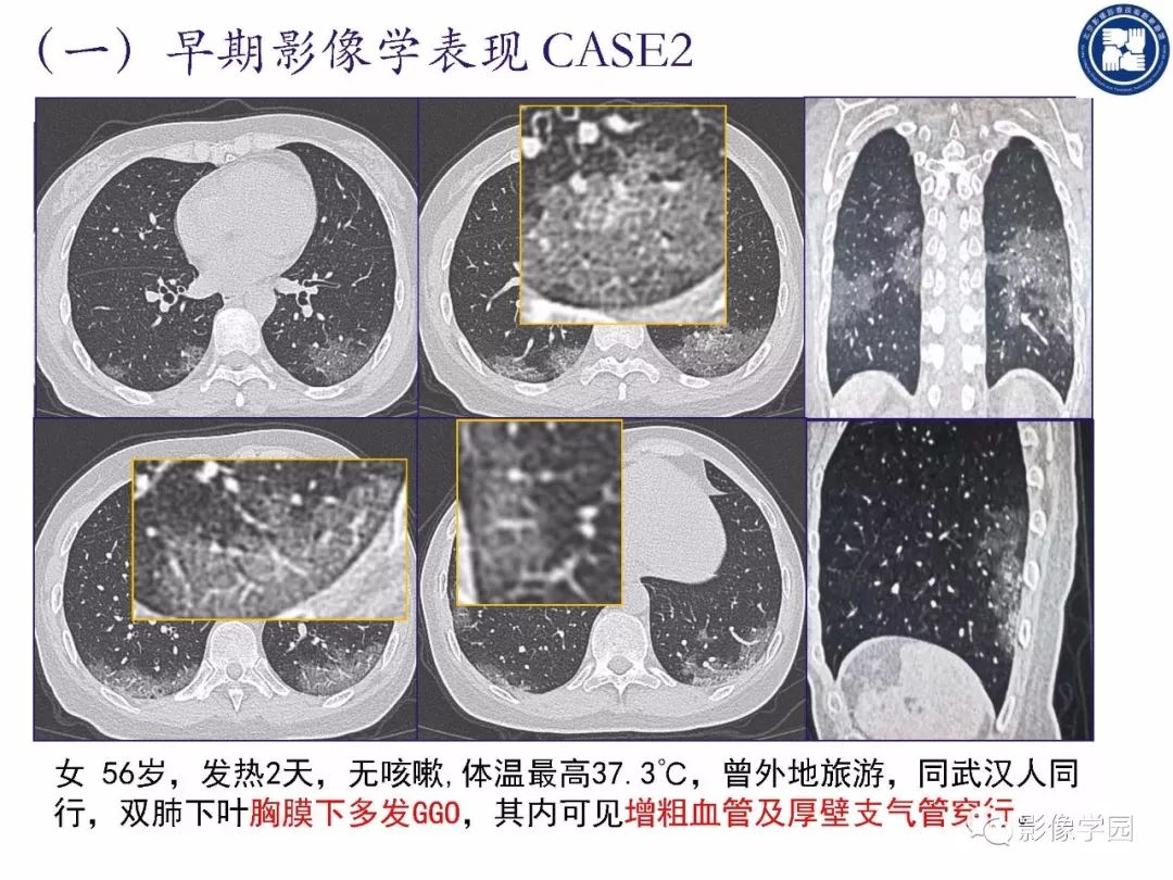 【PPT】新型冠状病毒肺炎影像学诊断指南解读