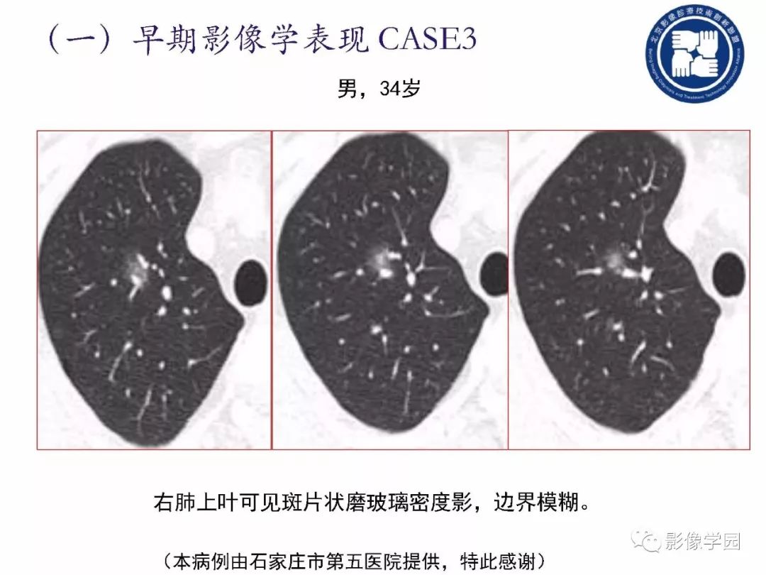【PPT】新型冠状病毒肺炎影像学诊断指南解读