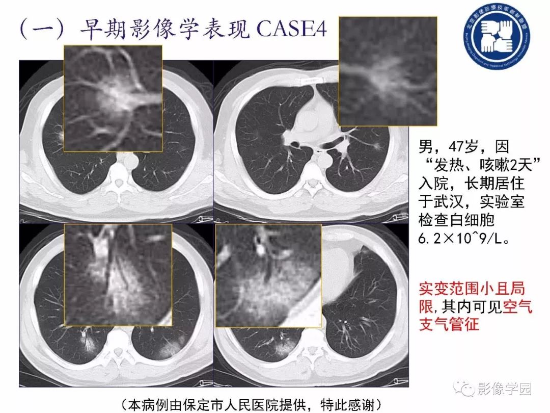 【PPT】新型冠状病毒肺炎影像学诊断指南解读