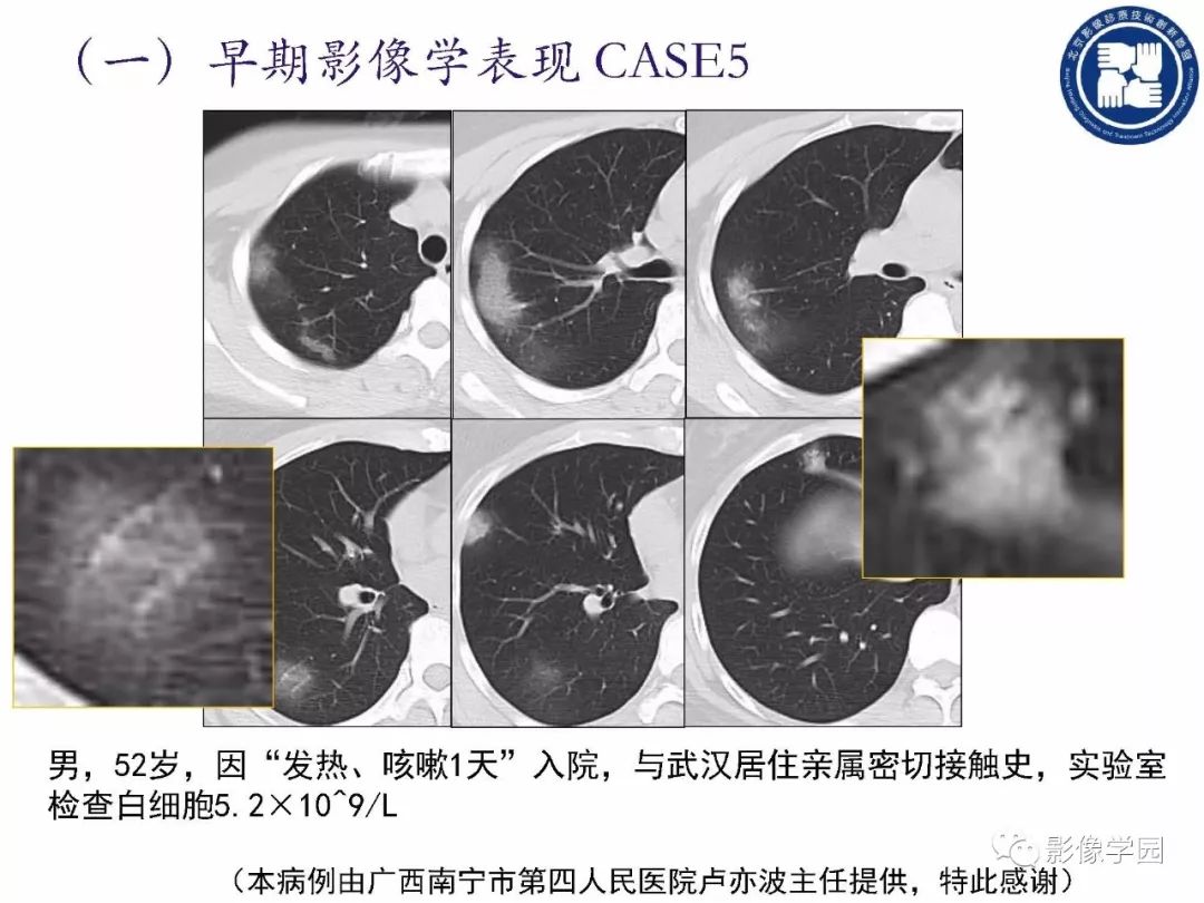【PPT】新型冠状病毒肺炎影像学诊断指南解读