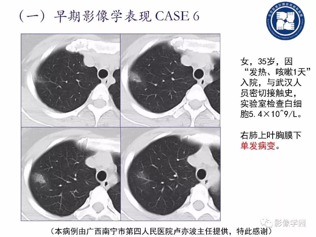 【PPT】新型冠状病毒肺炎影像学诊断指南解读