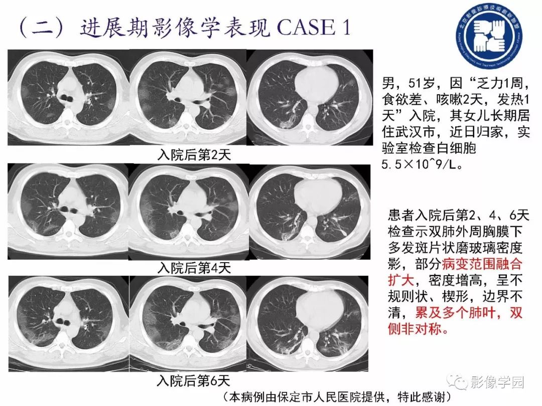 【PPT】新型冠状病毒肺炎影像学诊断指南解读