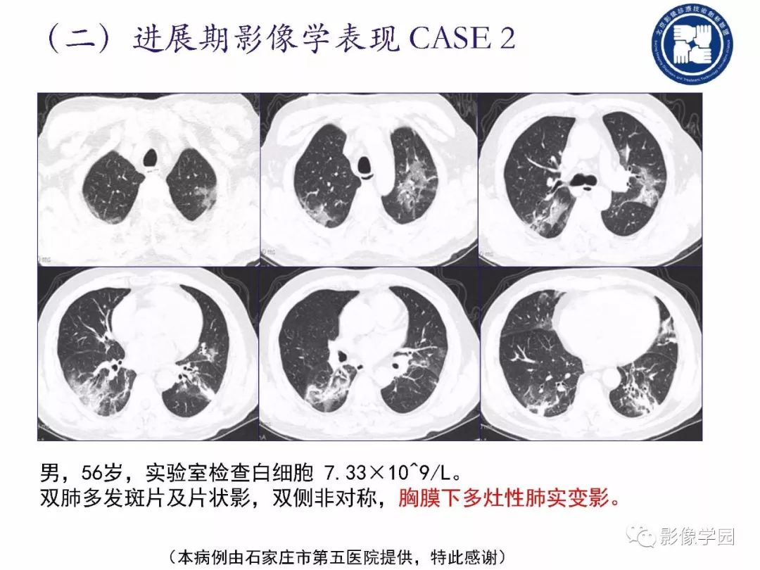 【PPT】新型冠状病毒肺炎影像学诊断指南解读