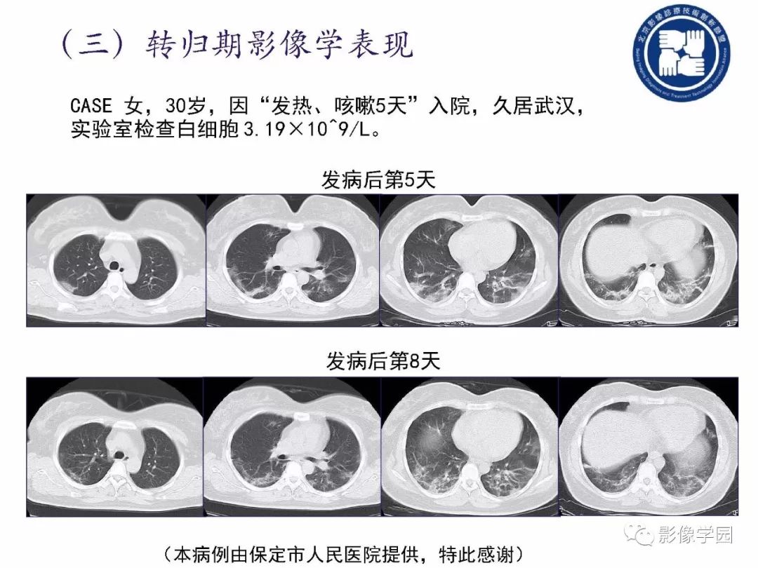 【PPT】新型冠状病毒肺炎影像学诊断指南解读