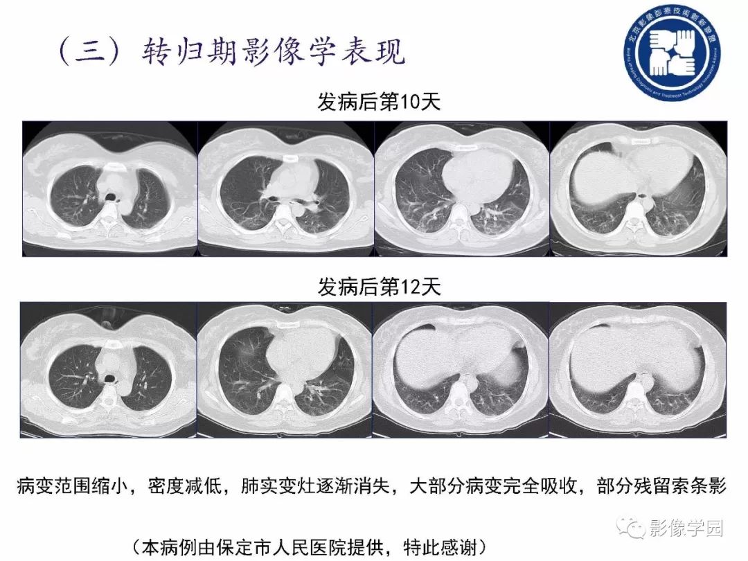 【PPT】新型冠状病毒肺炎影像学诊断指南解读