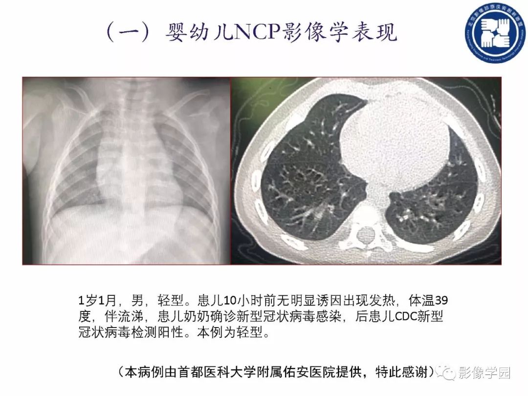 【PPT】新型冠状病毒肺炎影像学诊断指南解读