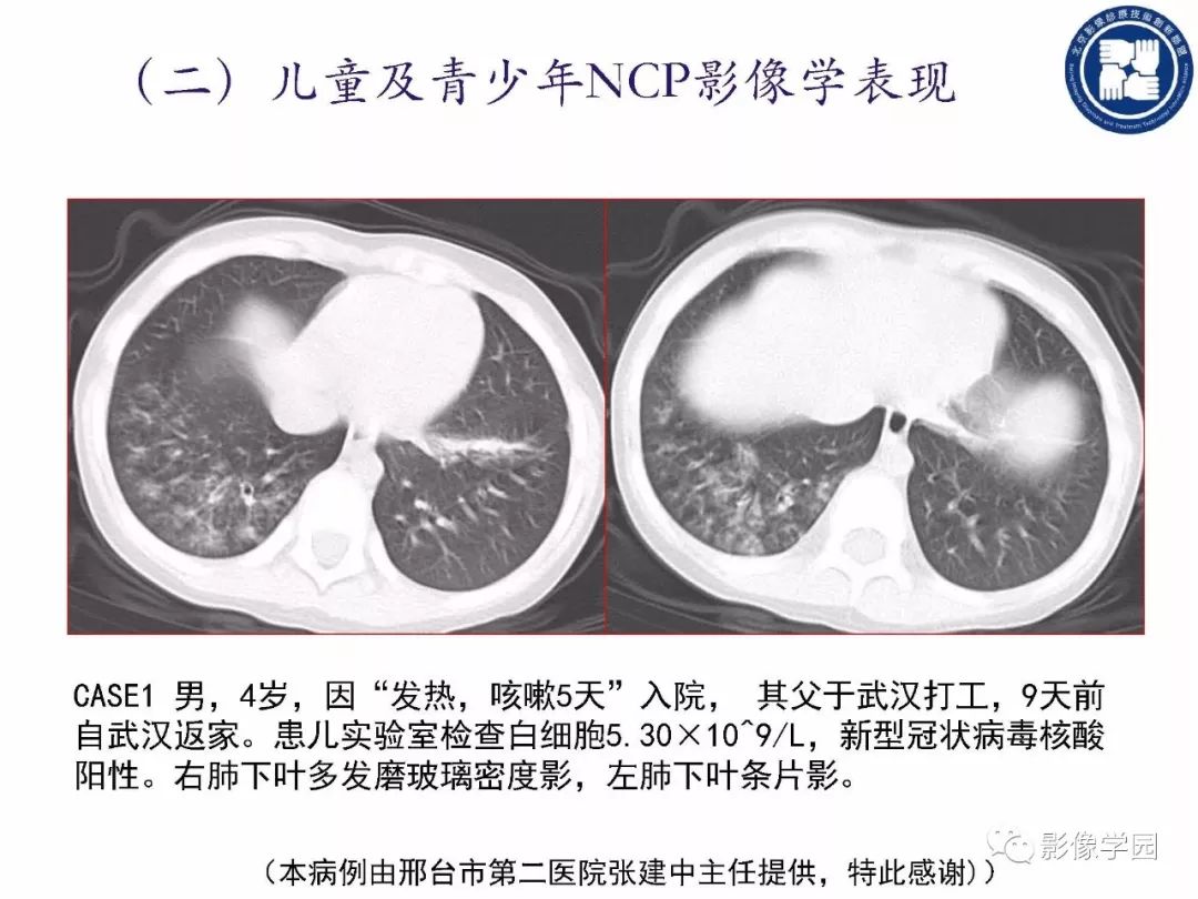 【PPT】新型冠状病毒肺炎影像学诊断指南解读