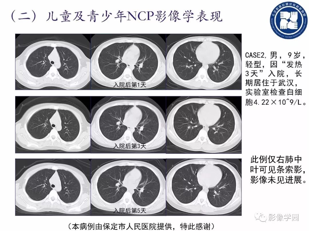【PPT】新型冠状病毒肺炎影像学诊断指南解读