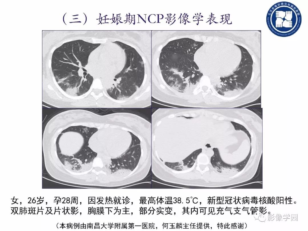 【PPT】新型冠状病毒肺炎影像学诊断指南解读