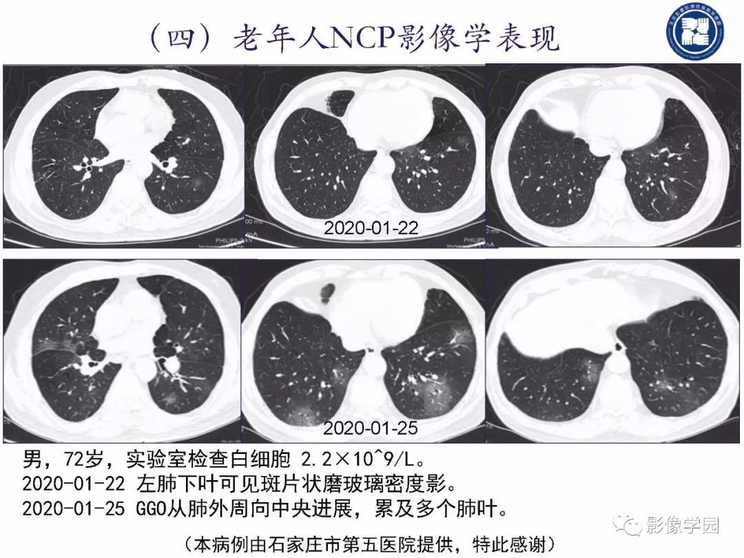 【PPT】新型冠状病毒肺炎影像学诊断指南解读