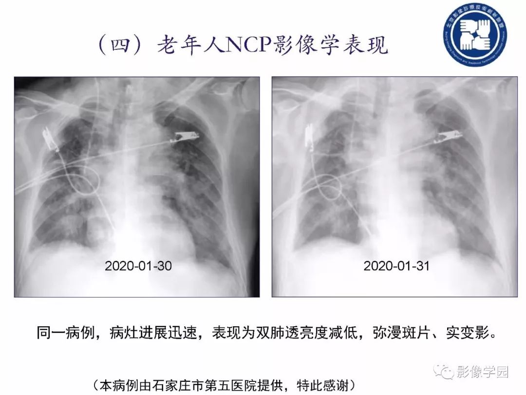 【PPT】新型冠状病毒肺炎影像学诊断指南解读