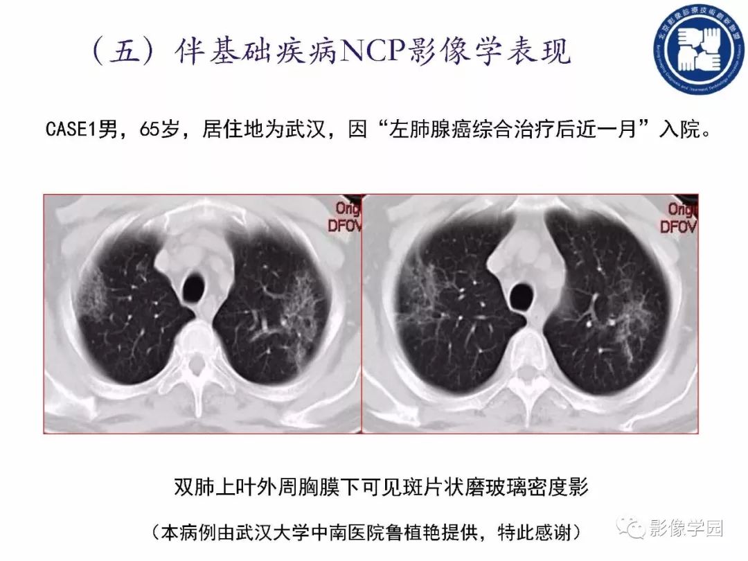 【PPT】新型冠状病毒肺炎影像学诊断指南解读