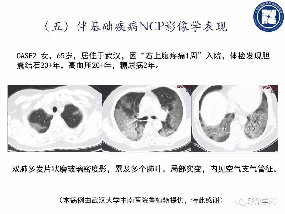 【PPT】新型冠状病毒肺炎影像学诊断指南解读