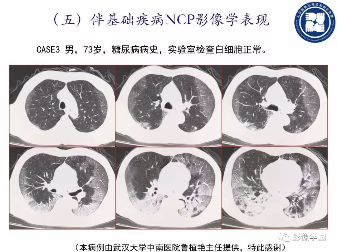 【PPT】新型冠状病毒肺炎影像学诊断指南解读