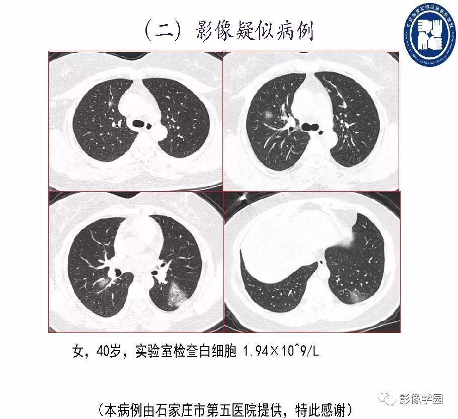 【PPT】新型冠状病毒肺炎影像学诊断指南解读