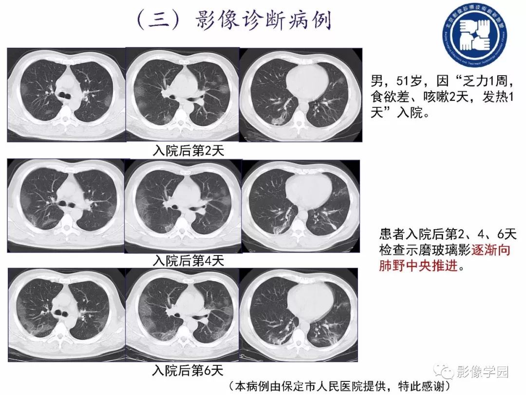 【PPT】新型冠状病毒肺炎影像学诊断指南解读