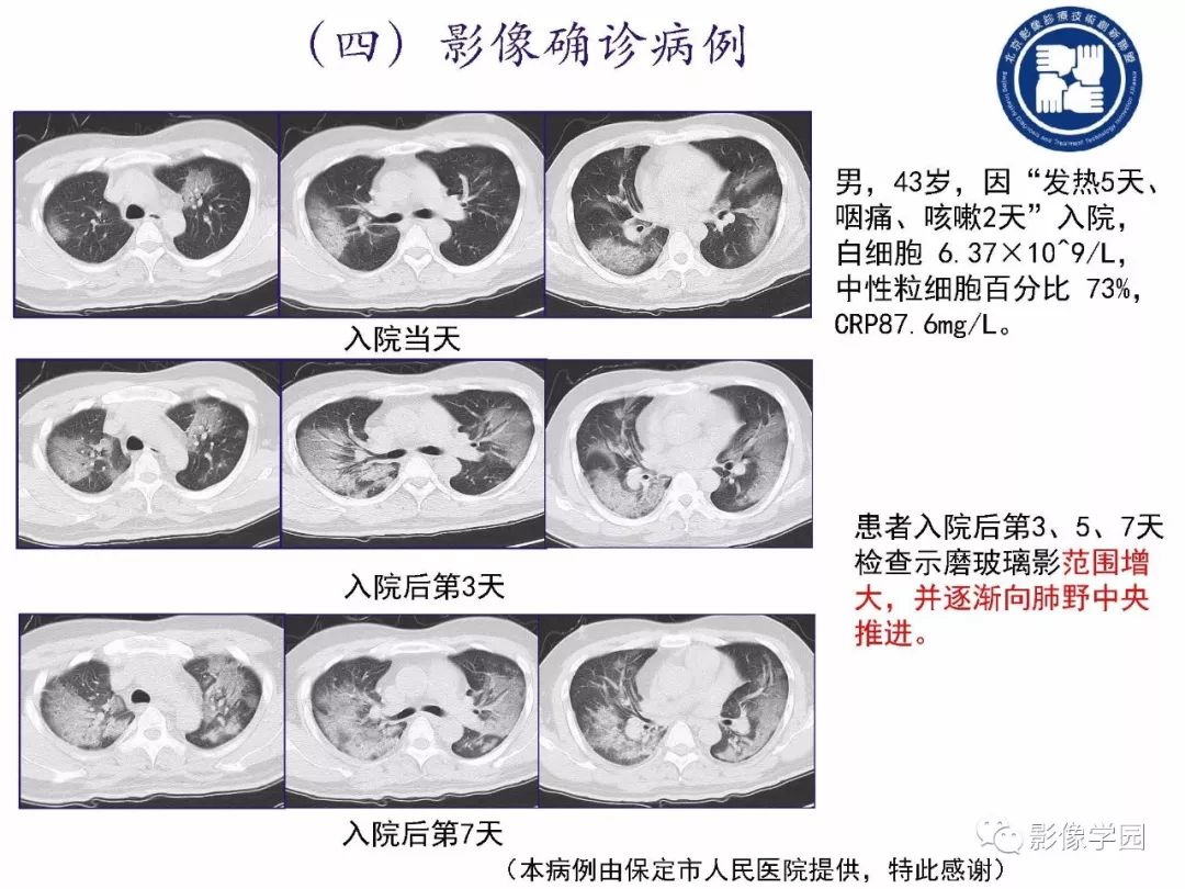【PPT】新型冠状病毒肺炎影像学诊断指南解读