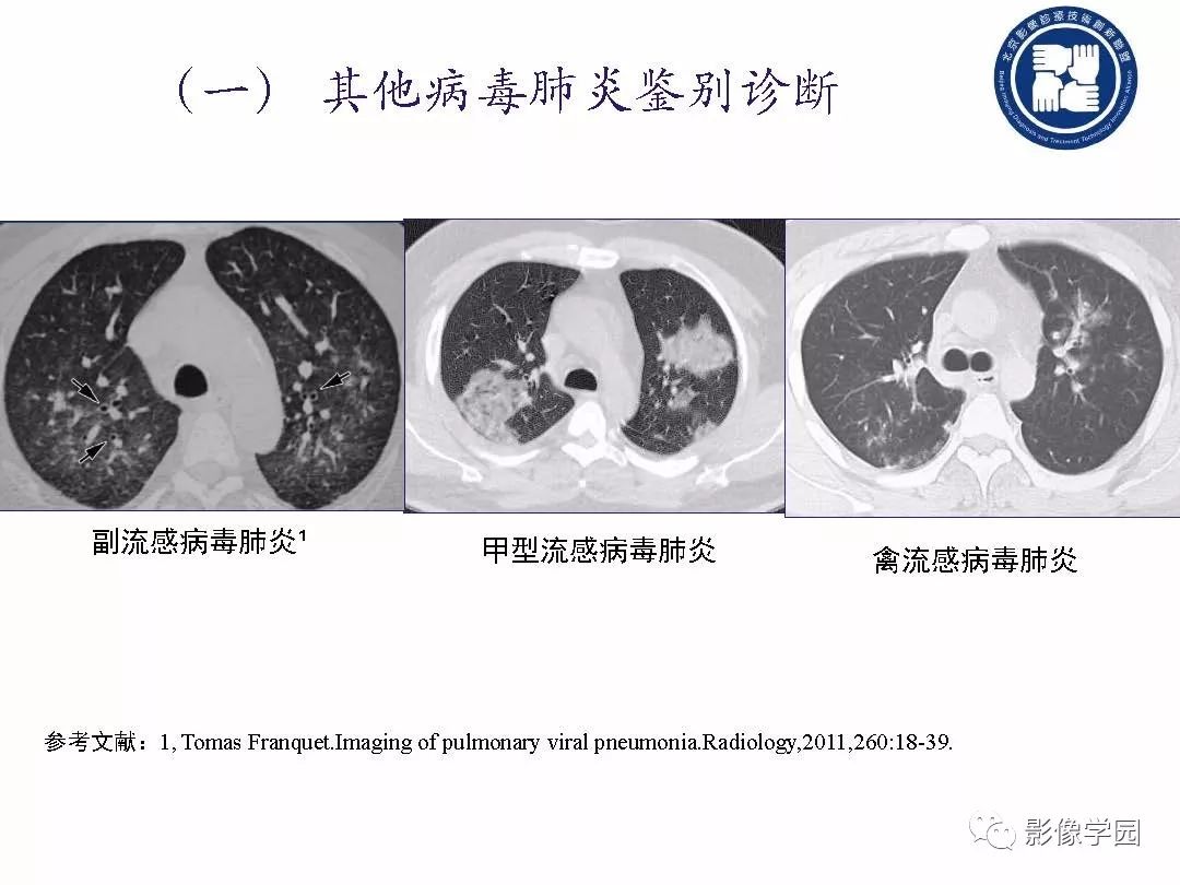 【PPT】新型冠状病毒肺炎影像学诊断指南解读